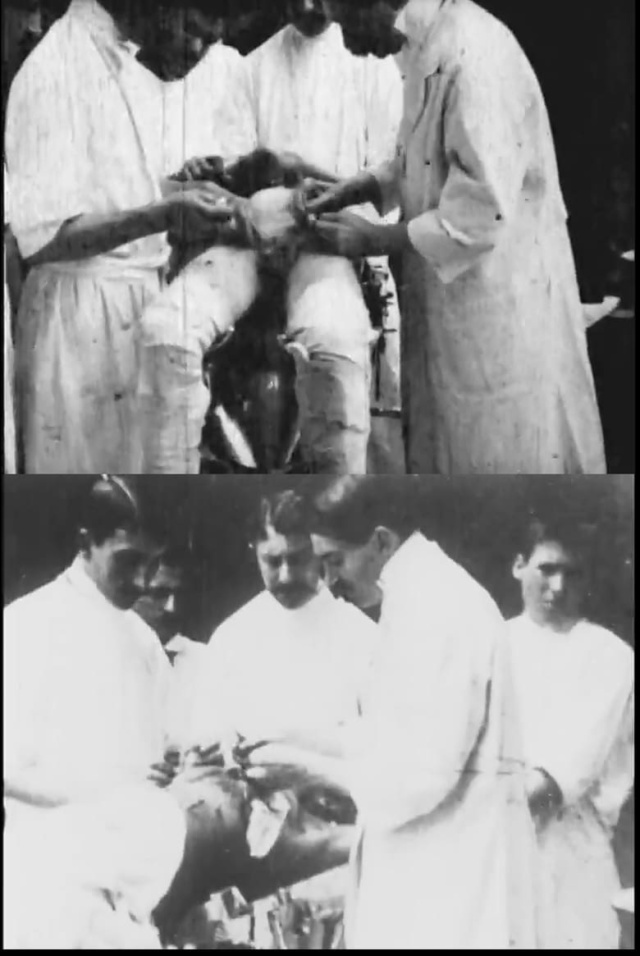 Pulmonary Hydatid Cyst Operation